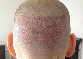 Greffe-de-cheveux-solution-permanente
