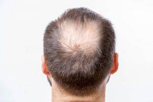 chute de cheveux alopecie et chimiotherapie
