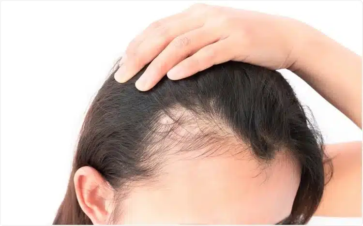 Preparer-cuir-chevelu-avant-greffe-de-cheveux