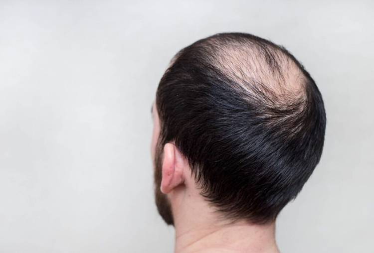 Hormones-genetique-alopecie-androgenetique